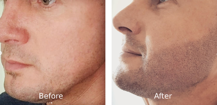 Beard Enhancement - Hairline Inc.