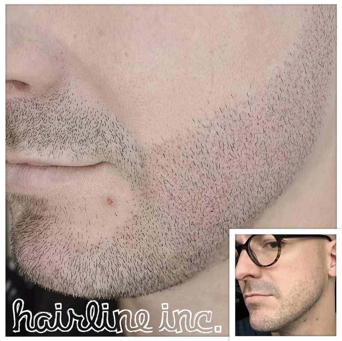 Beard Enhancement - Hairline Inc.