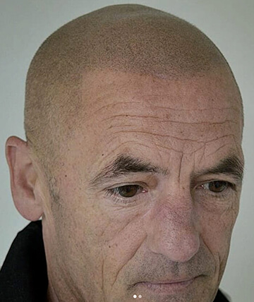scalp micropigmentation after picture